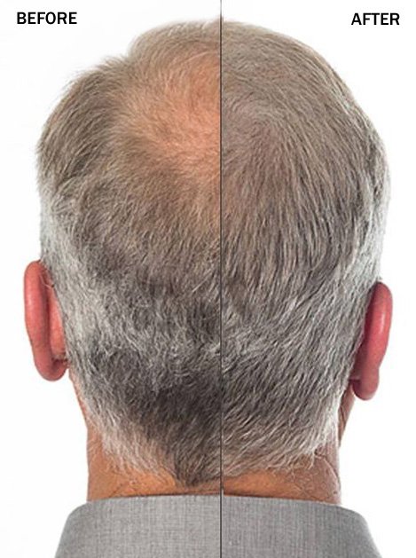 Kerathik hair fibes before after bald back spot