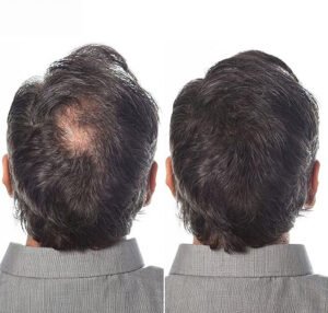 Kerathik hair fibes no more bald spot